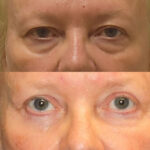 Thumbnail of http://Front%20view%20of%20eyelids%20and%20Blepharoplasty%20surgery%20by%20Dr.%20Zeiderman