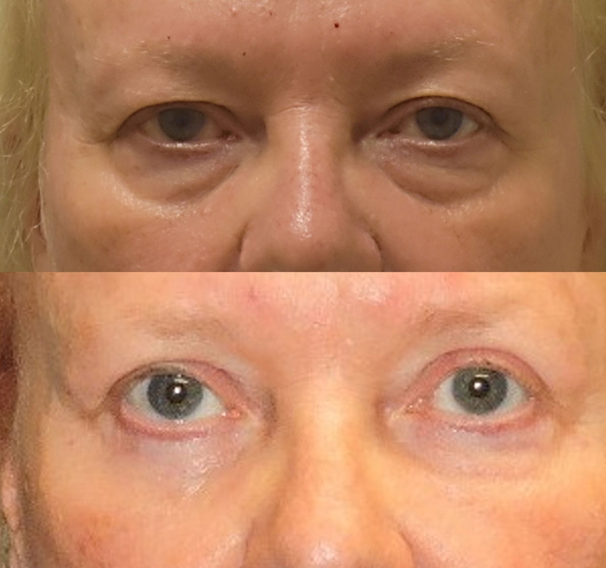 Front view of eyelids and Blepharoplasty surgery by Dr. Zeiderman
