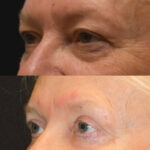 Thumbnail of http://Side%20view%20of%20eyelids%20and%20Blepharoplasty%20surgery%20by%20Dr.%20Zeiderman