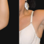 Thumbnail of http://Brachioplasty%20Arm%20Lift%20before%20and%20after%20by%20Dr%20Zeiderman