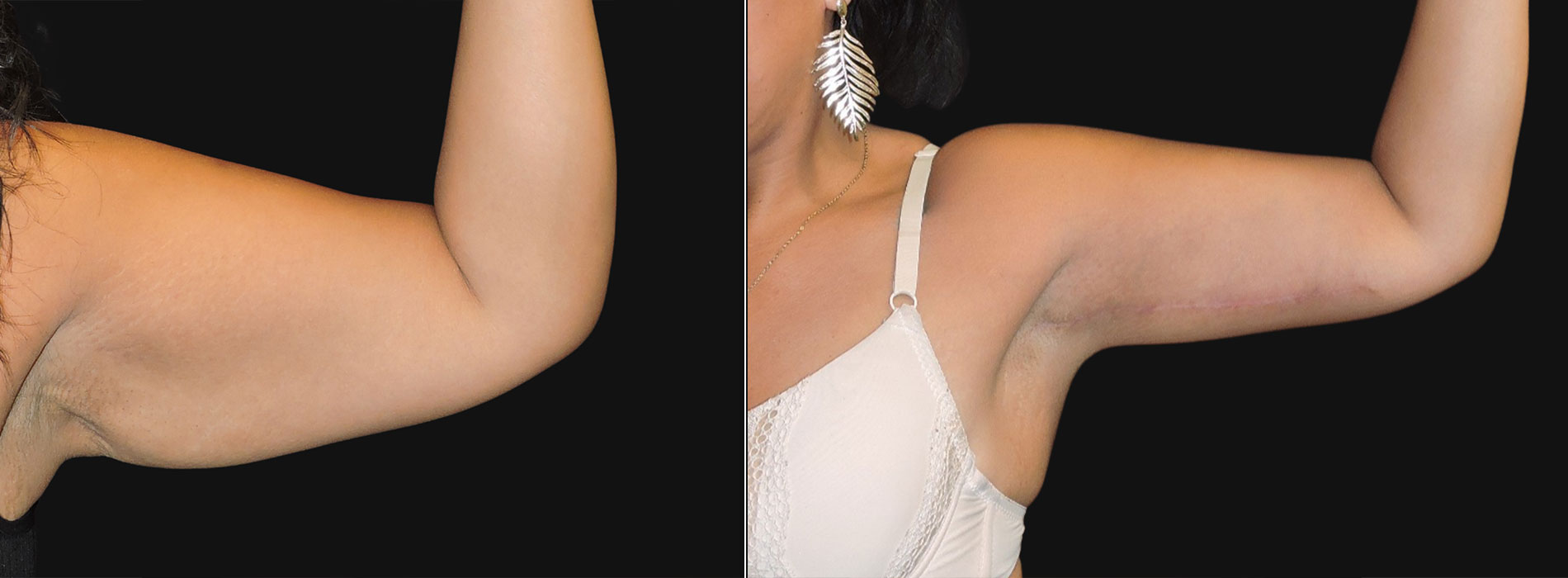 Brachioplasty Arm Lift before and after by Dr Zeiderman