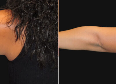 Brachioplasty Patient 3 – Dr. Zeiderman