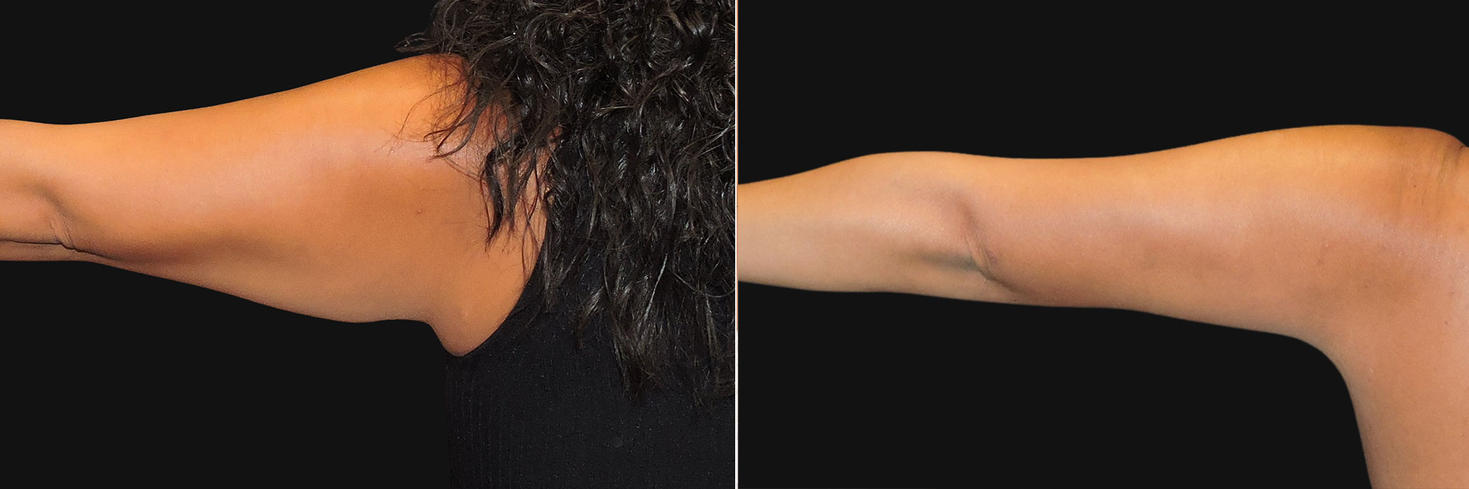Brachioplasty Arm Lift before and after, arm view straight out by Dr Zeiderman