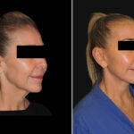 Thumbnail of http://before%20and%20after%20image%20of%20face%20and%20neck%20lift%20by%20Dr%20Zeiderman