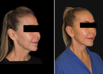 Facelift and Necklift Zeiderman Patient 5