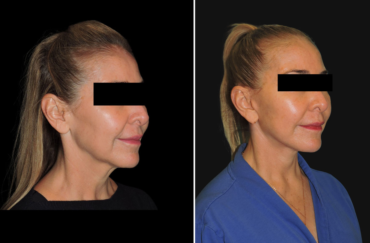 before and after image of face and neck lift by Dr Zeiderman