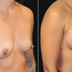 Thumbnail of http://breast%20augmentation%20before%20and%20after%20side%20view
