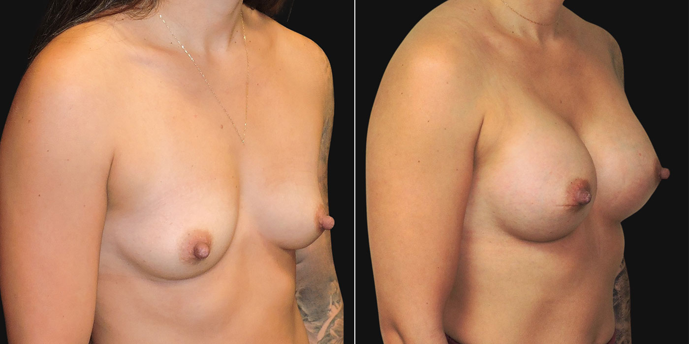 breast augmentation before and after side view