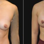 Thumbnail of http://breast%20augmentation%20before%20and%20after%20frontal%20view