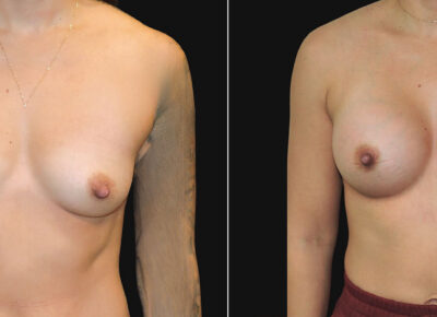 Breast Augmentation – Dr. Zeiderman – 5