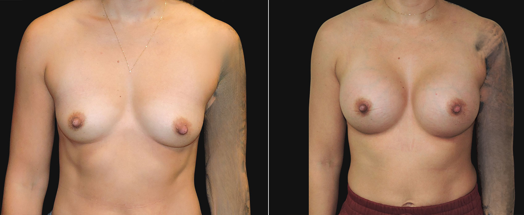 breast augmentation before and after frontal view