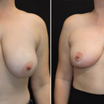 Thumbnail of http://breast%20lift%20with%20reduction%20before%20and%20after
