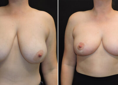 Breast Lift with Reduction – Dr Zeiderman