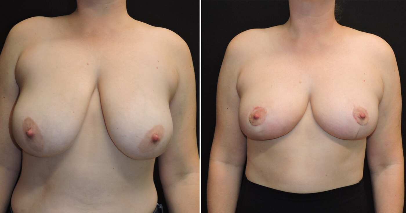 breast lift with reduction before and after
