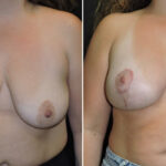 Thumbnail of http://beast%20lift%20with%20implants%20before%20and%20after