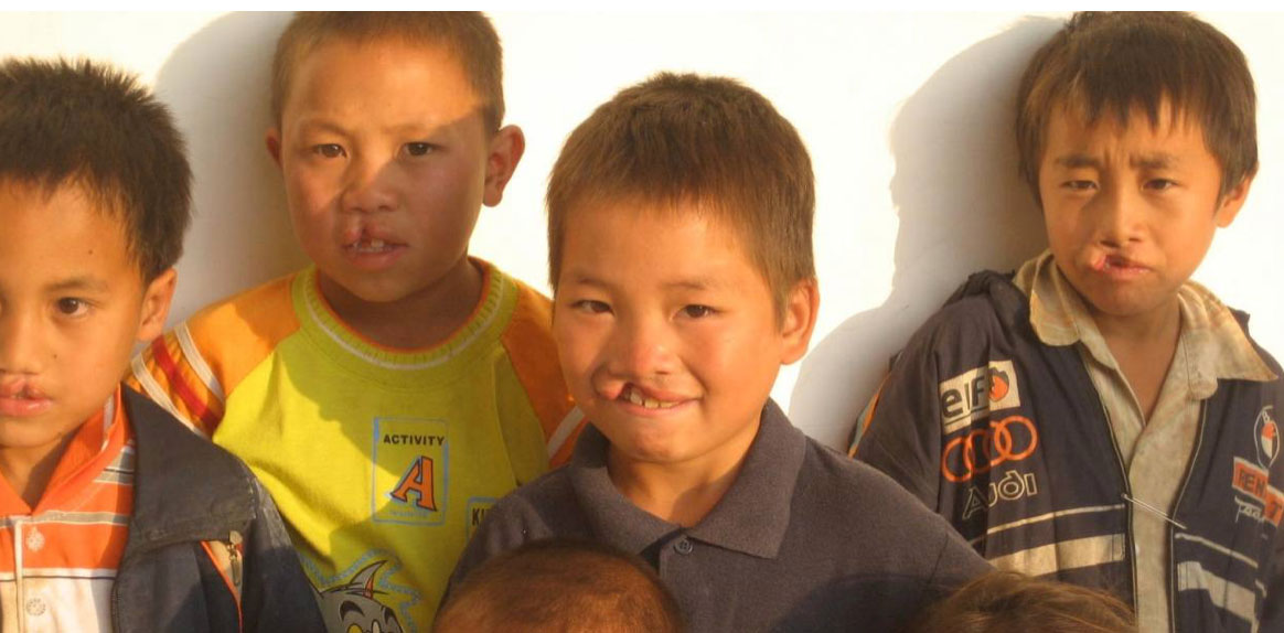 Children pictured during Dr. McClure’s cleft lip surgery mission and humanitarian outreach