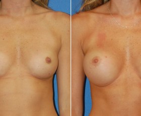 Dr. Snyder - Breast Augmentation