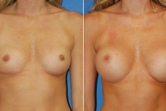 snyder-breast-aug-1a
