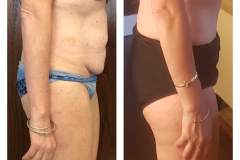 Lipoabdominoplasty-2B