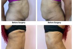 Lipoabdominoplasty-3B