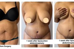 Lipoabdominoplasty-4A