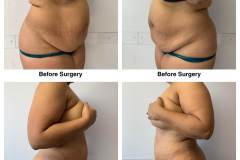 Lipoabdominoplasty-4B