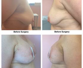 Dr. Tran - Breast Augmentation & Mastopexy