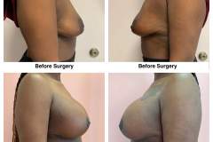 Breast-augmentation-mastopexy-1A