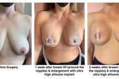 Breast-augmentation-mastopexy-2A