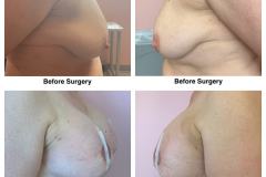 Breast-augmentation-mastopexy-2B