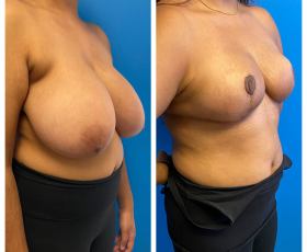 Dr. Tran - Breast Reduction