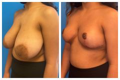 bao-Bilateral-Breast-Reduction-1b