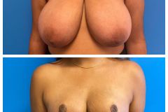 bao-Bilateral-Breast-Reduction-2a