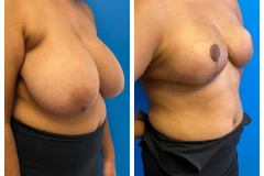 bao-Bilateral-Breast-Reduction-2b