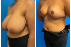 bao-Bilateral-Breast-Reduction-2c