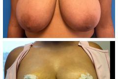 bao-Bilateral-Breast-Reduction-2d