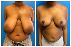 bao-Bilateral-Breast-Reduction-3a