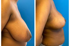 bao-Bilateral-Breast-Reduction-3b