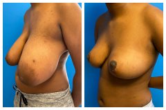 bao-Bilateral-Breast-Reduction-3d