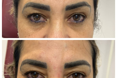 bao-injectables-101