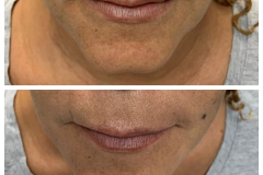 bao-injectables-102
