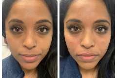 bao-injectables-13