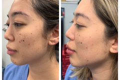 bao-injectables-17