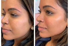 bao-injectables-32