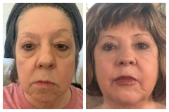 bao-injectables-41