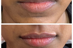 bao-injectables-52