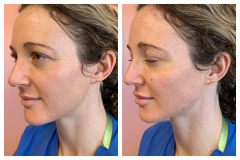 bao-injectables-56