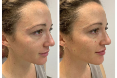 bao-injectables-68