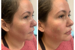 bao-injectables-8