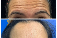 bao-injectables-95